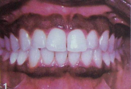Melanosis o Pigmentación Fisiológica