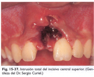 Intrusión Dental Total