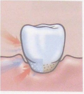 hipersensibilidad dental