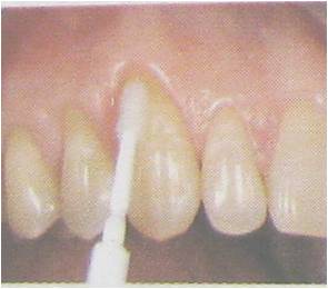 Acciones Importantes en la Hipersensibilidad Dental