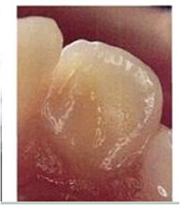 Dens Invaginatus (Dens in Dente)