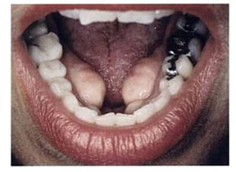 Torus mandibular