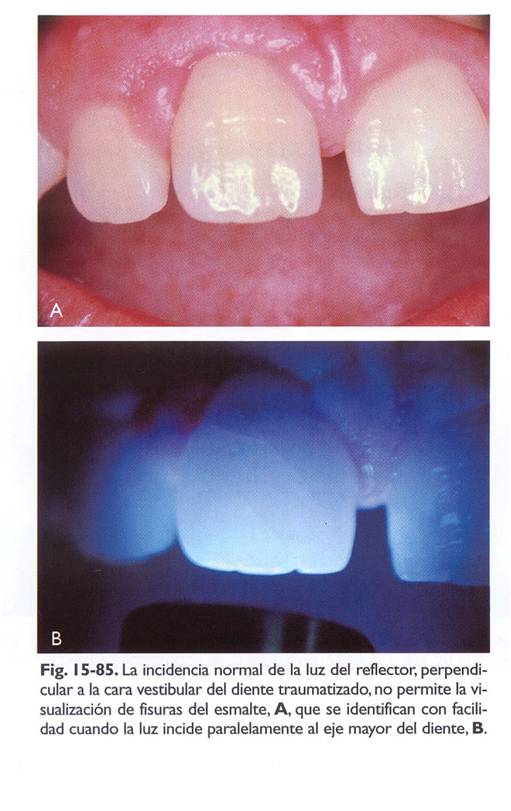 Fracturas coronarias del esmalte