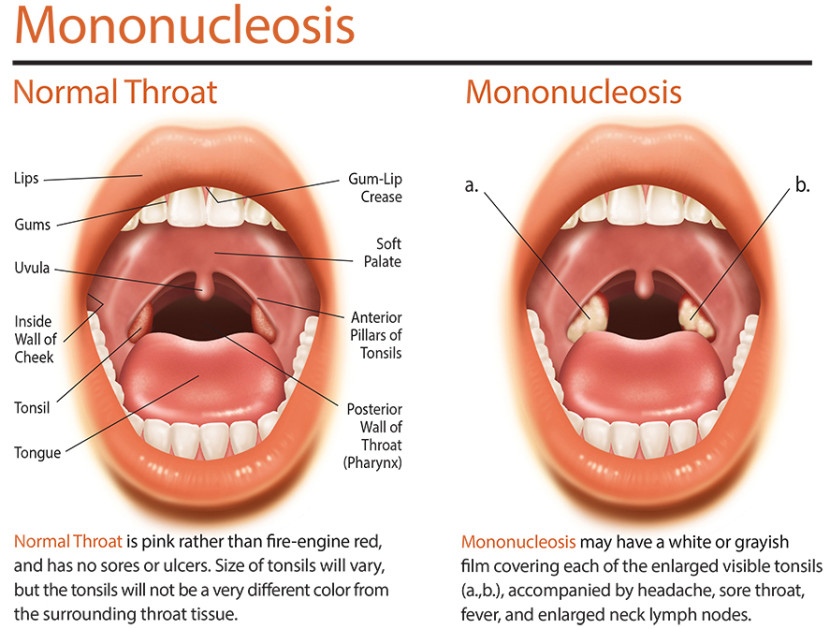 symptoms-of-mononucleosis-everyday-health