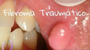 Fibroma Traum tico Odontoblog
